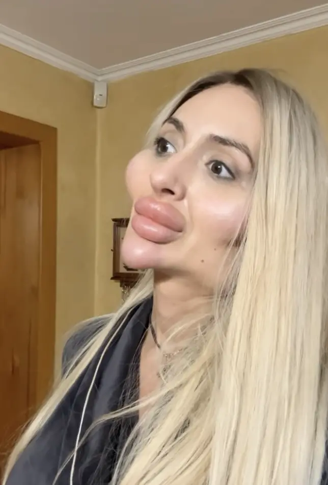 It’s her extreme cheeks that have garnered Anastasia Pokreshchuk the most attention.