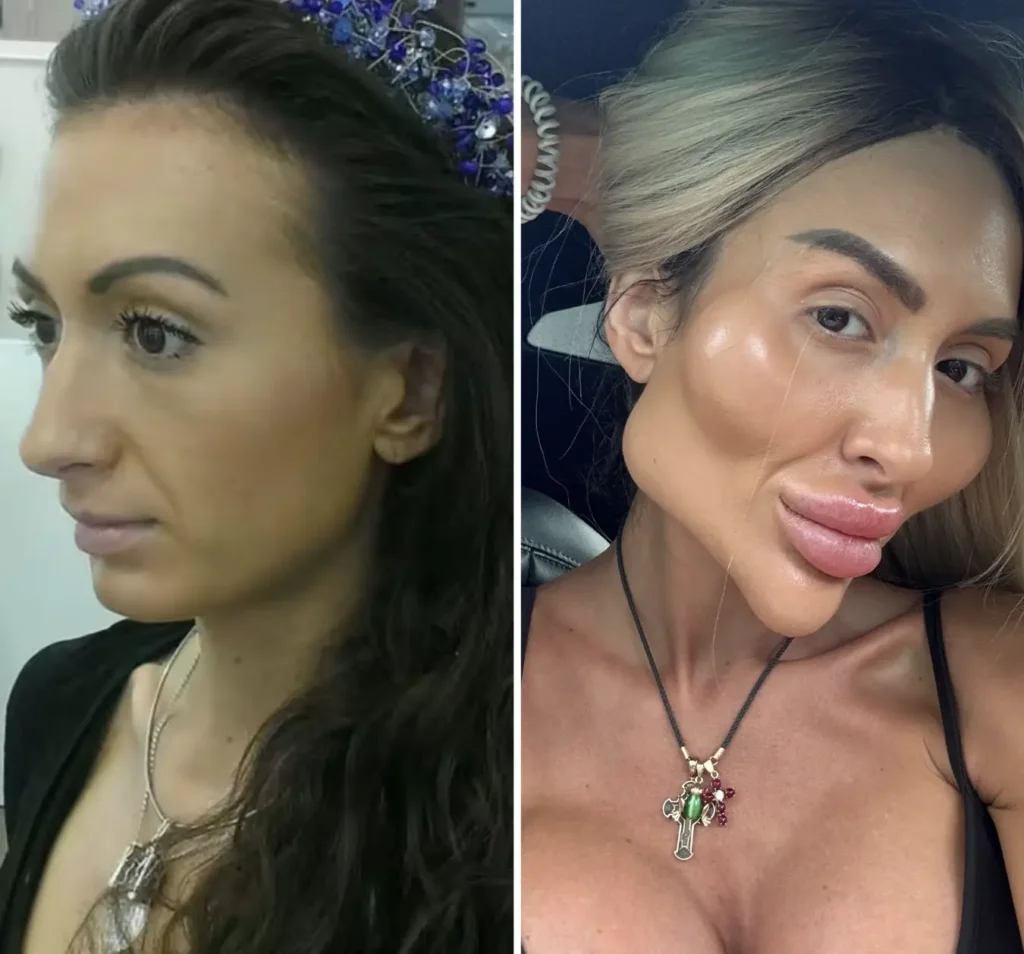 Anastasia Pokreshchuk has taken to TikTok to share a video containing images of her before she began pursuing her ‘world’s biggest cheeks’ title.
