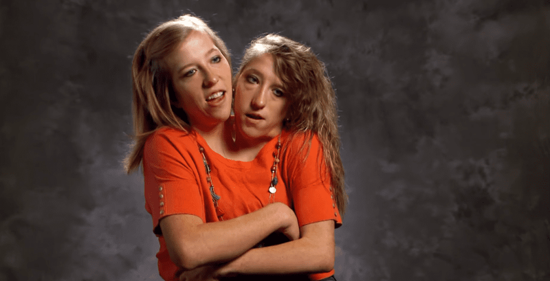 conjoined twins